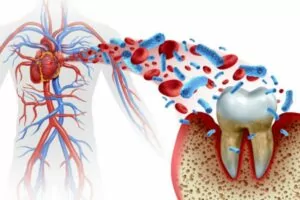 Monocytes linking gum disease to heart disease
