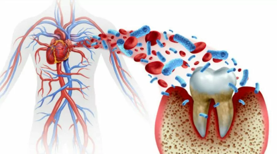 Monocytes linking gum disease to heart disease